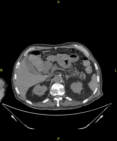 File:Aortoenteric fistula (Radiopaedia 84308-99603 Axial non-contrast 85).jpg