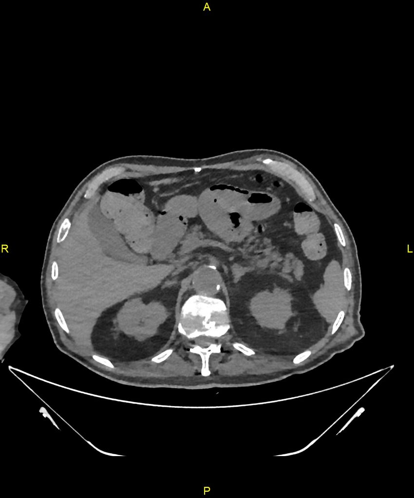 Aortoenteric fistula (Radiopaedia 84308-99603 Axial non-contrast 85).jpg