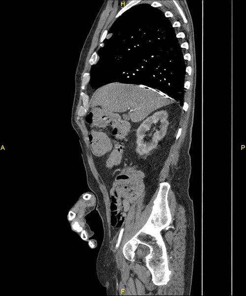 File:Aortoenteric fistula (Radiopaedia 84308-99603 C 101).jpg