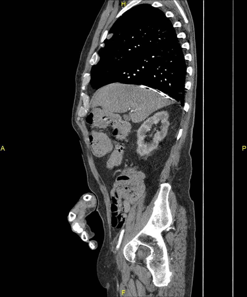 Aortoenteric fistula (Radiopaedia 84308-99603 C 101).jpg