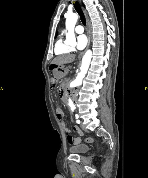 File:Aortoenteric fistula (Radiopaedia 84308-99603 C 188).jpg