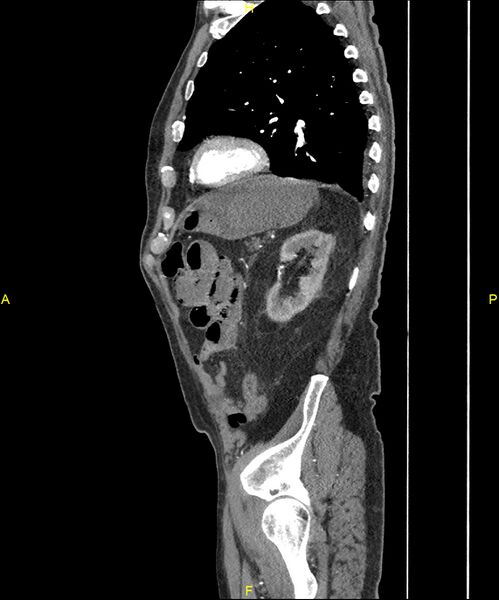 File:Aortoenteric fistula (Radiopaedia 84308-99603 C 257).jpg