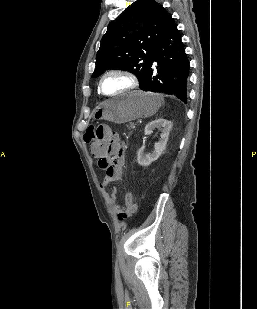 Aortoenteric fistula (Radiopaedia 84308-99603 C 257).jpg