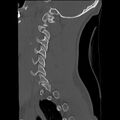 Apical pneumothorax on cervical spine CT (Radiopaedia 45343-49368 Sagittal bone window 28).jpg