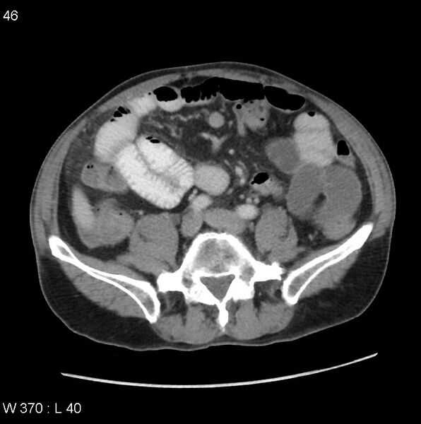 File:Appendicitis (Radiopaedia 27446-27642 A 25).jpg