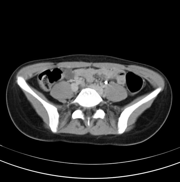 File:Appendicitis and incidental bicornuate uterus (Radiopaedia 22833-22853 Axial C+ delayed 25).jpg