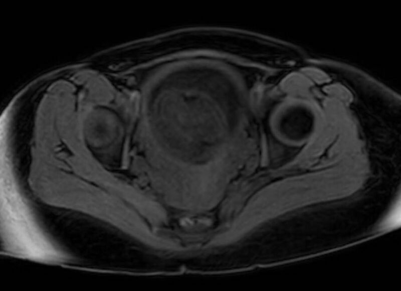 File:Appendicitis in gravida (MRI) (Radiopaedia 89433-106395 Axial DIXON 134).jpg