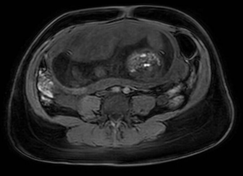 Appendicitis in gravida (MRI) (Radiopaedia 89433-106395 Axial DIXON 84).jpg
