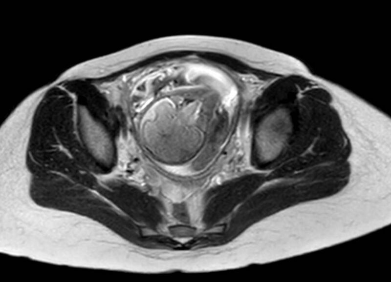 File:Appendicitis in gravida (MRI) (Radiopaedia 89433-106395 Axial T2 60).jpg