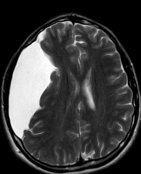 File:Arachnoid cyst- extremely large (Radiopaedia 68741-78451 Axial T2 17).jpg