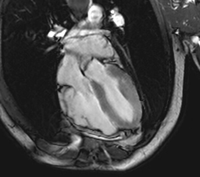 File:Arrhythmogenic right ventricular cardiomyopathy (Radiopaedia 39806-42237 D 8).jpg