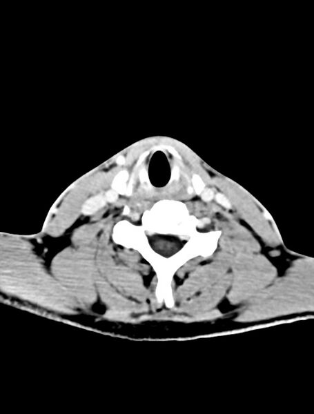 File:Arrow injury to the face (Radiopaedia 73267-84011 Axial C+ delayed 2).jpg