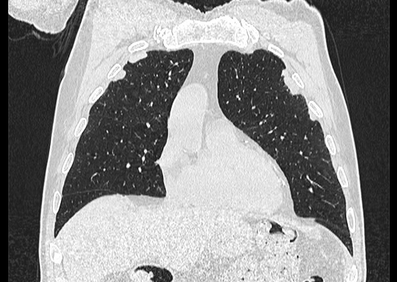 File:Asbestos pleural placques (Radiopaedia 57905-64872 Coronal lung window 75).jpg