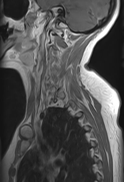 File:Astrocytoma - spinal cord (Radiopaedia 69769-79758 Sagittal T1 C+ 1).jpg