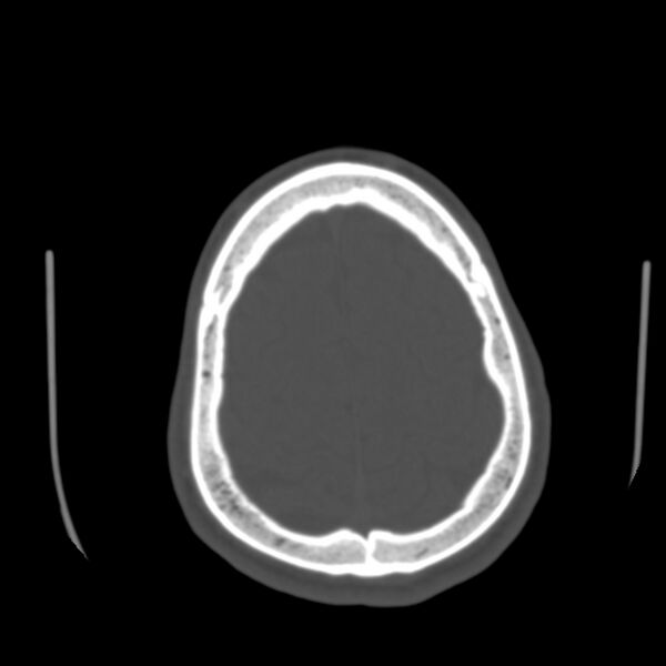 File:Asymptomatic occipital spur (Radiopaedia 87753-104201 Axial bone window 179).jpg