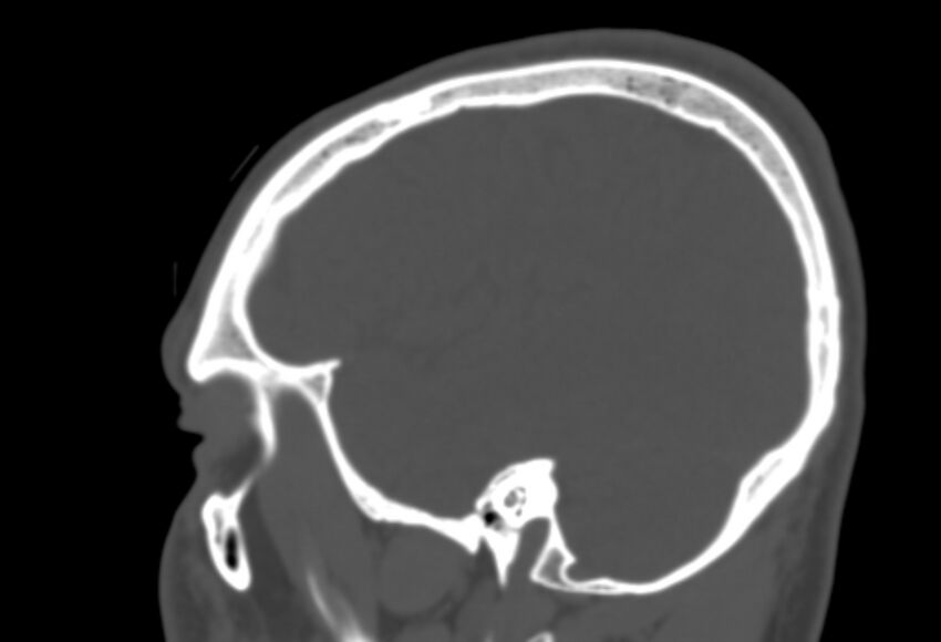 Asymptomatic occipital spur (Radiopaedia 87753-104201 Sagittal bone window 242).jpg