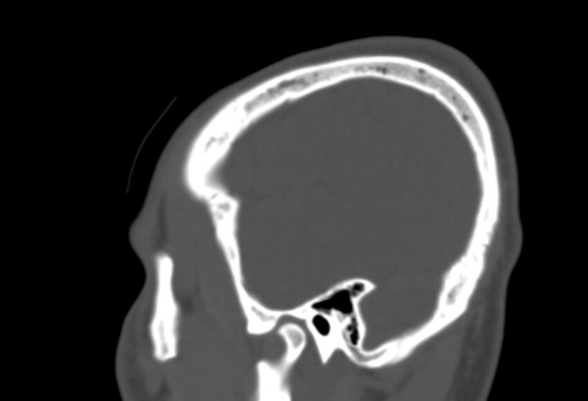 Asymptomatic occipital spur (Radiopaedia 87753-104201 Sagittal bone window 268).jpg