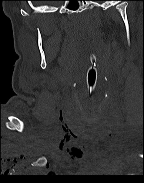 File:Atlanto-occipital dissociation - Traynelis type 1 (Radiopaedia 87570-103948 Coronal bone window 15).jpg