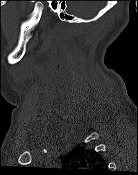 File:Atlanto-occipital dissociation - Traynelis type 1 (Radiopaedia 87570-103948 Sagittal bone window 65).jpg