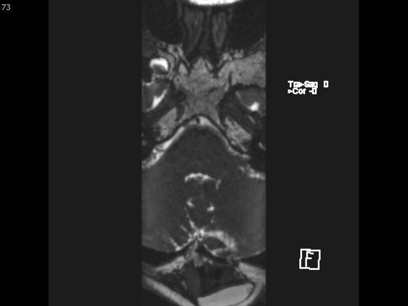 File:Atypical meningioma - intraosseous (Radiopaedia 64915-74572 Axial CISS 73).jpg