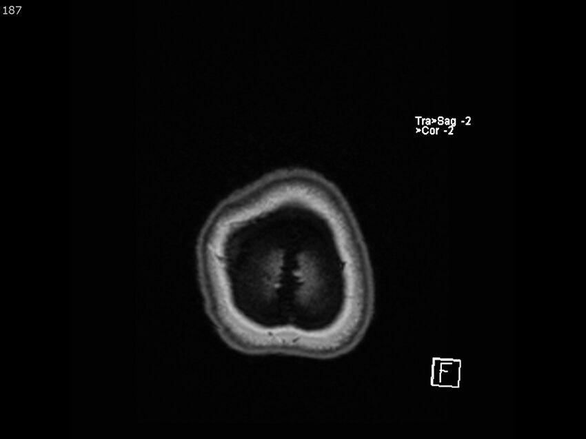 Atypical meningioma - intraosseous (Radiopaedia 64915-74572 Axial T1 187).jpg
