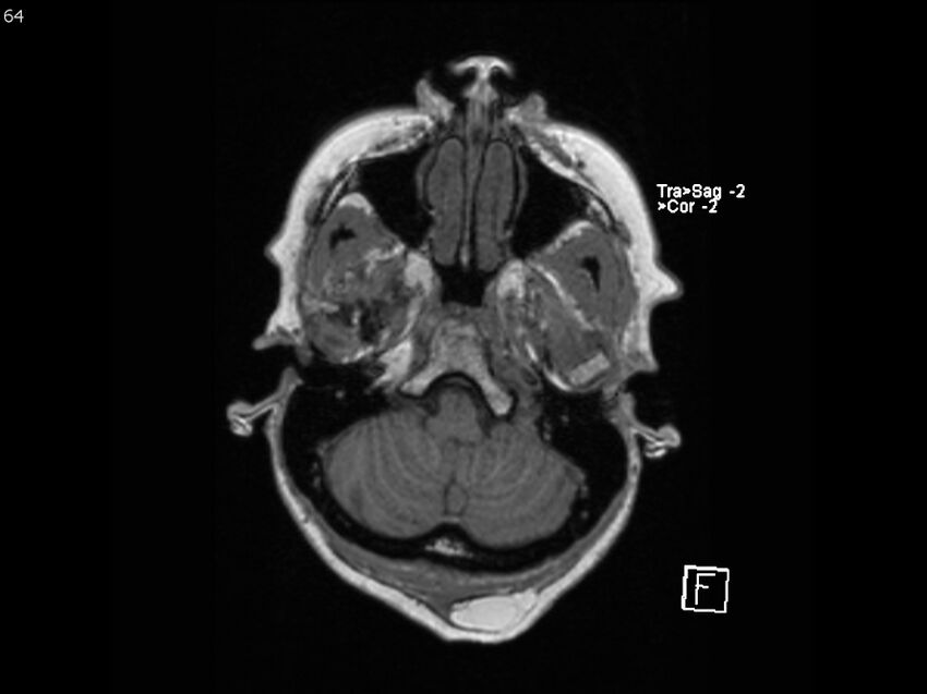 Atypical meningioma - intraosseous (Radiopaedia 64915-74572 Axial T1 64).jpg