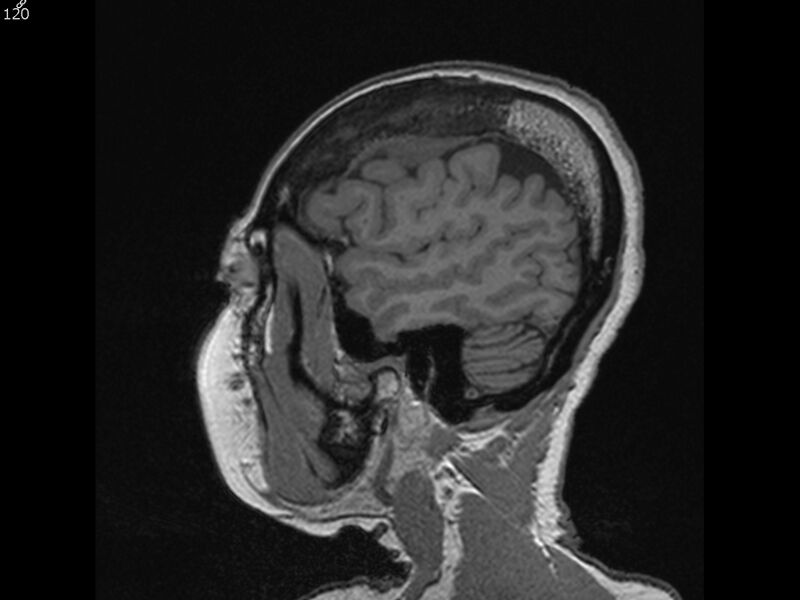 File:Atypical meningioma - intraosseous (Radiopaedia 64915-74572 Sagittal T1 120).jpg