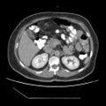 Atypical retroperitoneal lymphocoeles with large leiomyoma of uterus (Radiopaedia 32084-33024 A 15).jpg