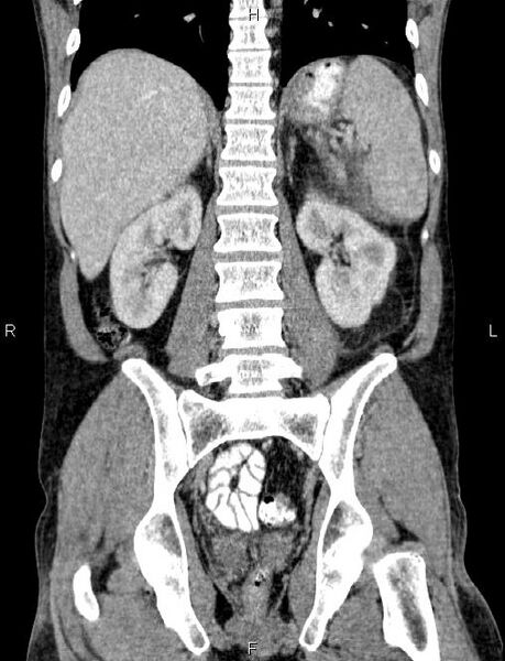 File:Autoimmune pancreatitis (Radiopaedia 84925-100431 D 41).jpg