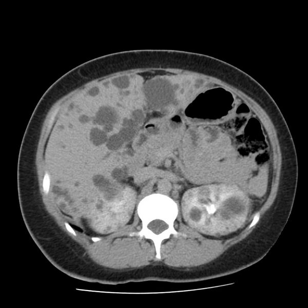 File:Autosomal dominant polycystic kidney disease (Radiopaedia 23061-23093 C+ delayed 23).jpg