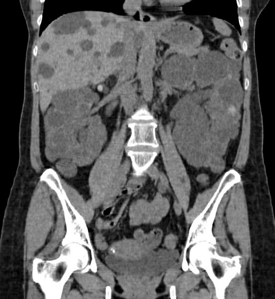File:Autosomal dominant polycystic kidney disease (Radiopaedia 41918-44922 Coronal non-contrast 23).jpg