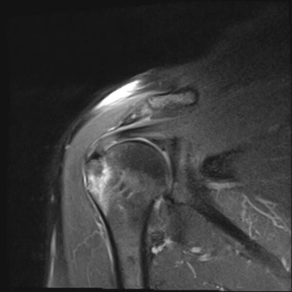 File:Avulsion fracture - greater tuberosity of humerus (Radiopaedia 71216-81515 Coronal PD fat sat 10).jpg