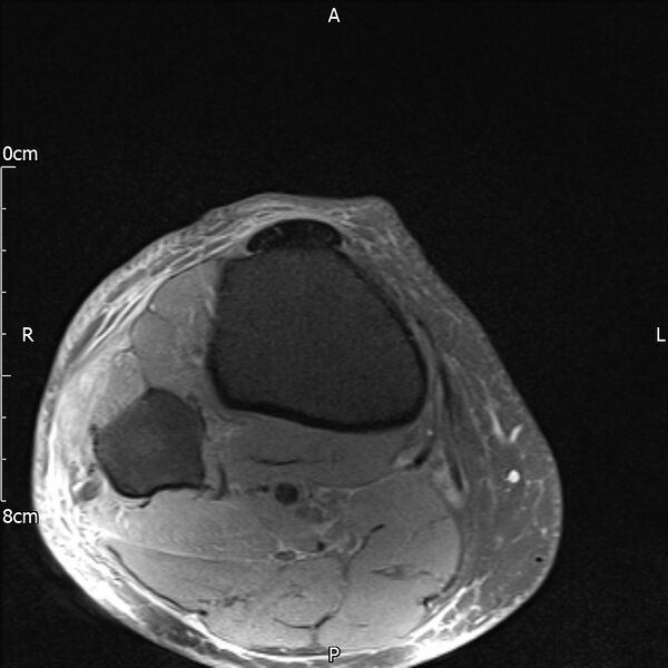 File:Avulsion fracture of the fibular head (Radiopaedia 74804-85808 Axial PD fat sat 35).jpg