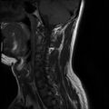 Axis fracture - MRI (Radiopaedia 71925-82375 Sagittal T1 7).jpg
