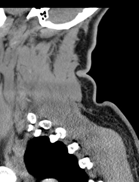 File:Axis peg fracture (type 3) and atlas lateral mass (type 4) fracture (Radiopaedia 37474-39324 D 61).png