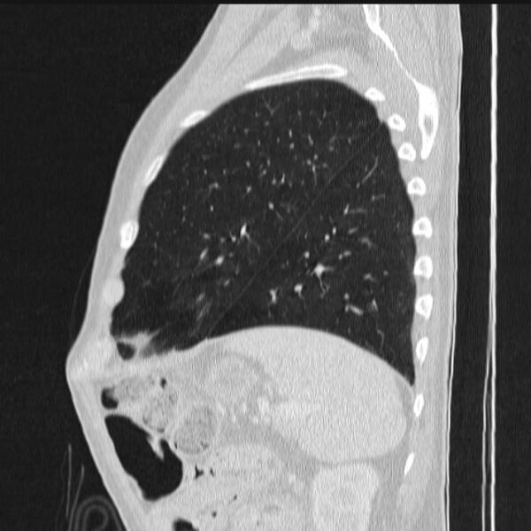 File:Azygos lobe (Radiopaedia 38259-40275 lung window 80).jpg