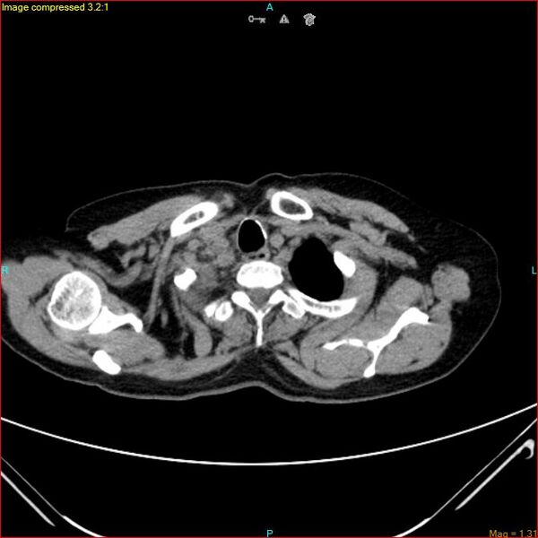 File:Azygos vein aneurysm (Radiopaedia 77824-90130 A 8).jpg