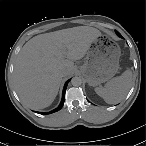 File:Azygos venous system anatomy (CT pulmonary angiography) (Radiopaedia 25928-26077 Axial C+ CTPA 84).jpg