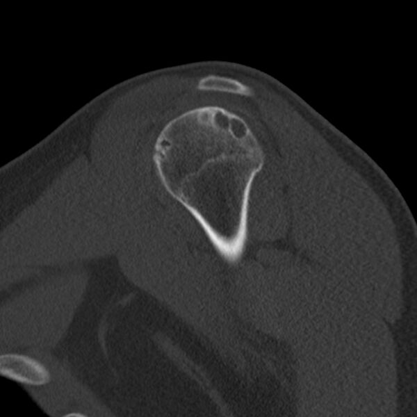 File:Bankart lesion (Radiopaedia 22771-22798 Sagittal bone window 15).jpg