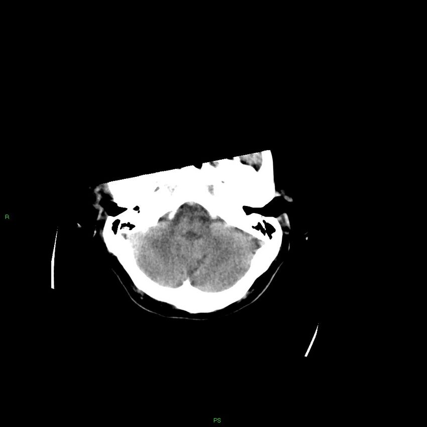 Basal ganglia hemorrhage (Radiopaedia 58349-65472 Axial non-contrast 47).jpg