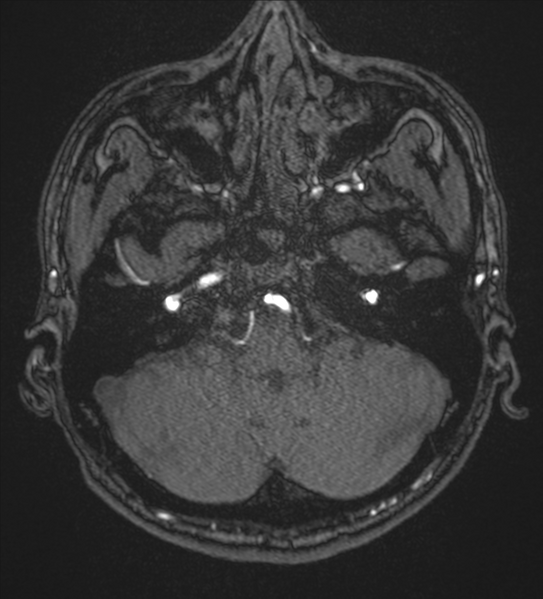 File:Basal ganglia subacute infarct (Radiopaedia 80201-93521 Axial MRA 6).png