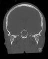 Base of skull fracture with bilateral Le Fort fractures (Radiopaedia 47094-51638 Coronal bone window 51).jpg