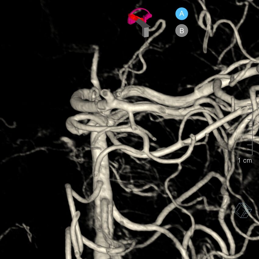Basilar artery perforator aneurysm (Radiopaedia 82455-97734 3D view left VA 172).jpg