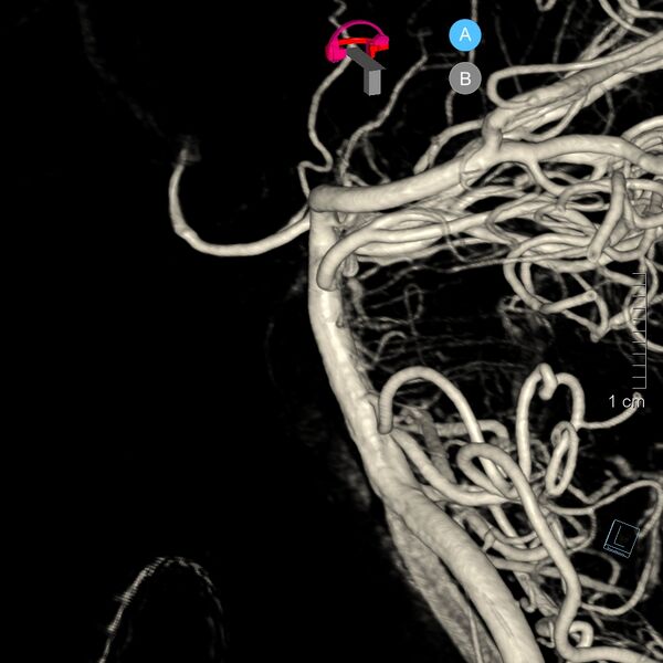 File:Basilar artery perforator aneurysm (Radiopaedia 82455-97734 3D view left VA 21).jpg