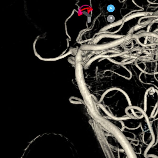 File:Basilar artery perforator aneurysm (Radiopaedia 82455-97734 3D view left VA 26).jpg
