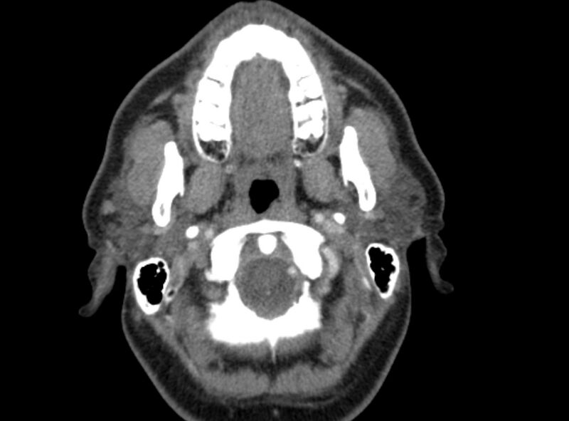 File:Benign mixed salivary tumor of the parotid gland (Radiopaedia 35261-36792 A 15).jpg