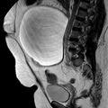 Benign seromucinous cystadenoma of the ovary (Radiopaedia 71065-81300 Sagittal T2 10).jpg