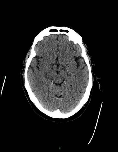 File:Bilateral acute middle cerebral artery territory infarcts (Radiopaedia 77319-89401 Axial non-contrast 35).jpg