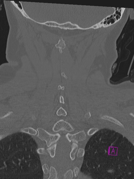 File:Bilateral atlanto-occipital assimilation (Radiopaedia 28350-28603 Coronal bone window 37).jpg