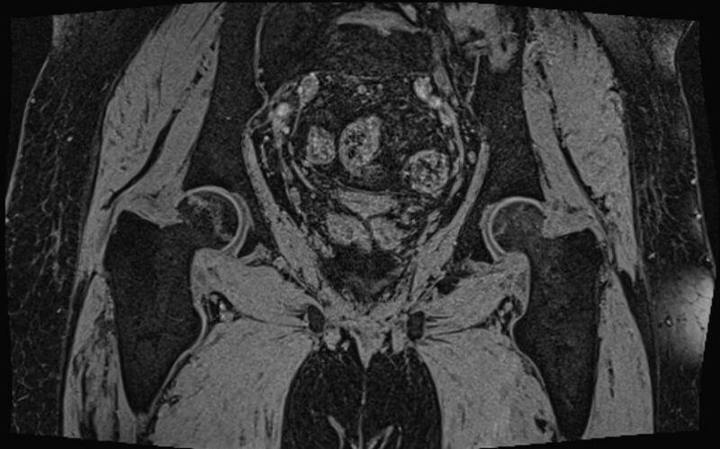 File:Bilateral avascular necrosis of femoral head (Radiopaedia 77116-89078 Coronal T2 we 22).jpg